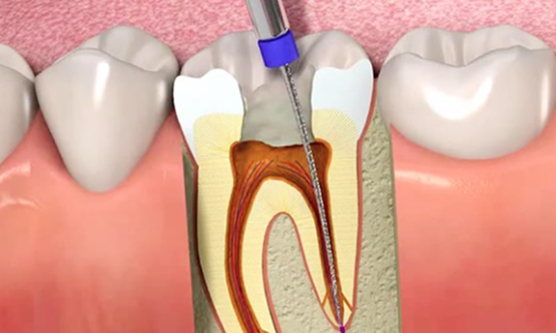 Kanal Tedavisi Endodonti
